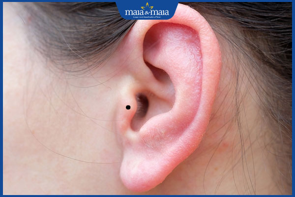 nốt ruồi ở phong đương trái