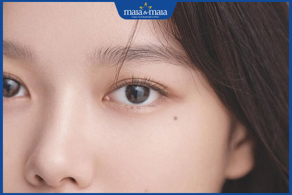 nốt ruồi ở quanh mắt