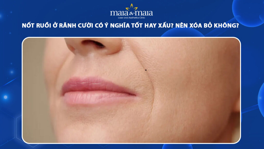 nốt ruồi ở rãnh cười