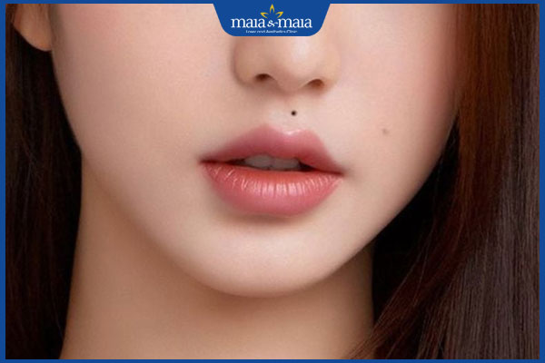 nốt ruồi ở rãnh nhân trung