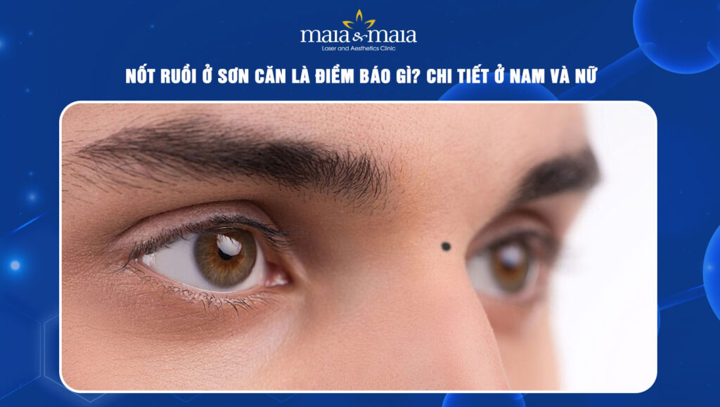 Nốt ruồi ở sơn căn