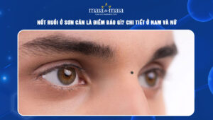 Nốt ruồi ở sơn căn