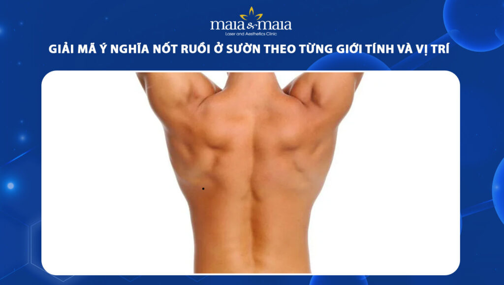 nốt ruồi ở sườn