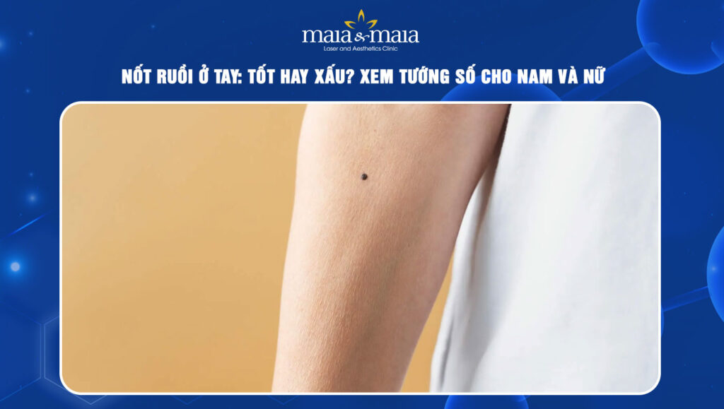 Nốt ruồi ở tay