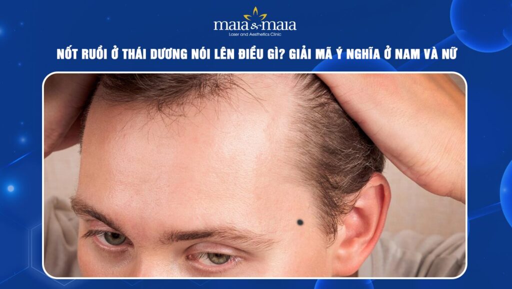 nốt ruồi ở thái dương