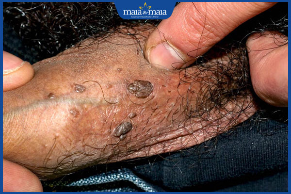 nốt ruồi ở thân dương vật