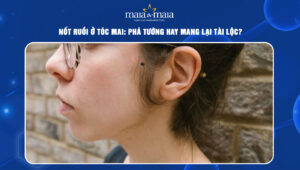 Nốt ruồi ở tóc mai