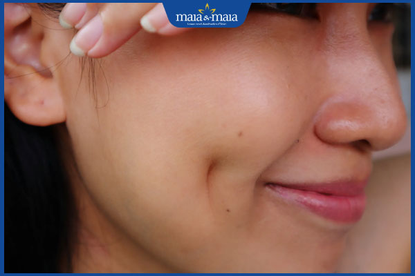 nốt ruồi ở trên má lúm