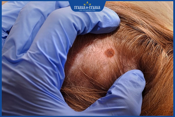 nốt ruồi ở trong tóc