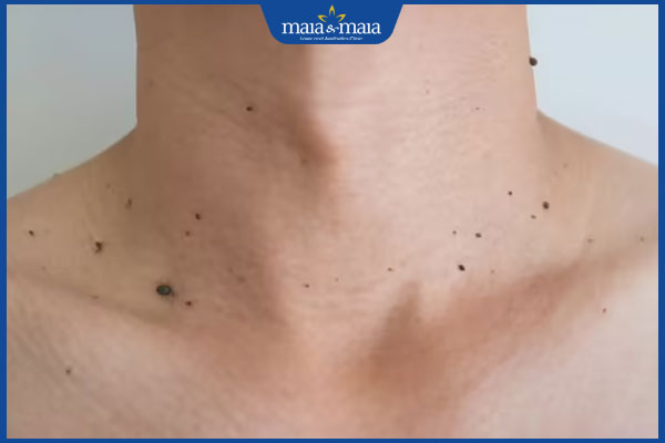 Tìm hiểu ý nghĩa nốt ruồi ở cổ qua từng vị trí cụ thể 4 nốt ruồi ở trước cổ