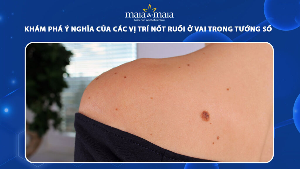 Ý nghĩa các vị trí nốt ruồi ở vai trong nhân tướng học 1 nốt ruồi ở vai