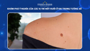 nốt ruồi ở vai