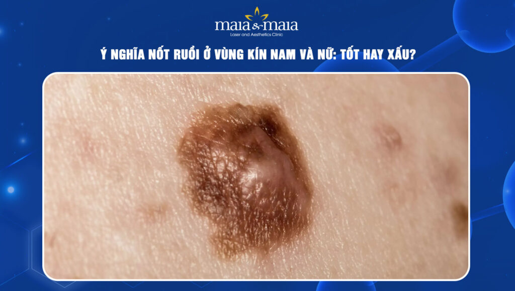 Nốt ruồi ở vùng kín