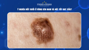 Nốt ruồi ở vùng kín