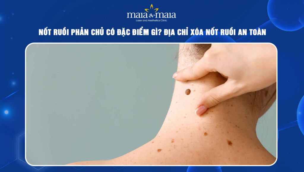 Nốt ruồi phản chủ