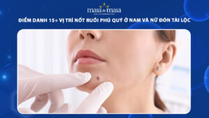 nốt ruồi phú quý
