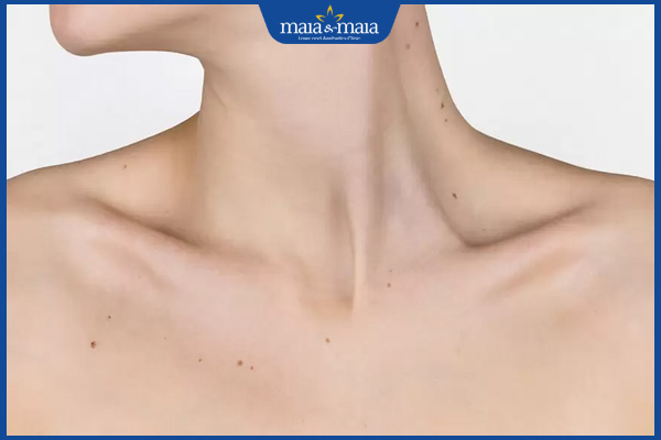 nốt ruồi quanh xương quai xanh