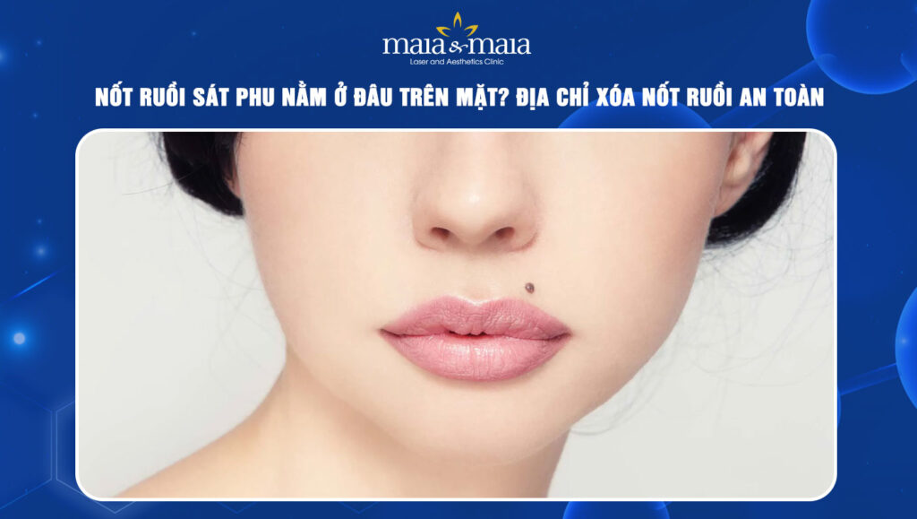 nốt ruồi sát phu