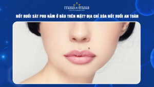 nốt ruồi sát phu