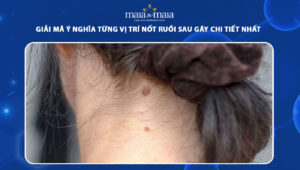 nốt ruồi sau gáy