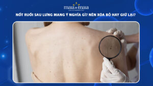 nốt ruồi sau lưng