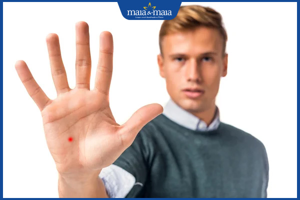 nốt ruồi son bàn tay nam