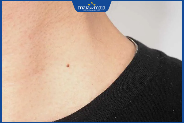 Nốt ruồi son ở cổ có ý nghĩa gì? Đây là tốt hay xấu? 4 nốt ruồi son cổ nam