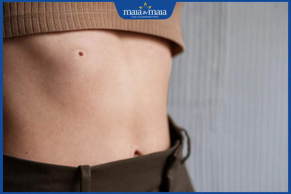 nốt ruồi son dưới ngực