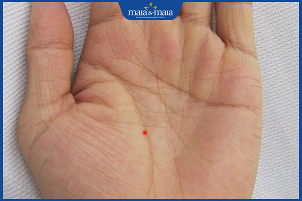 nốt ruồi son đường chỉ tay