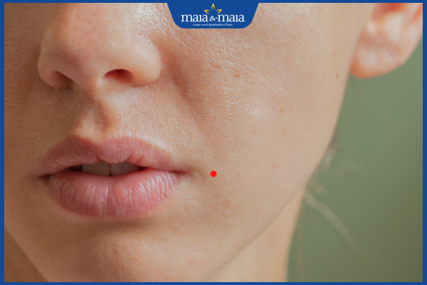 Nốt ruồi son khóe miệng