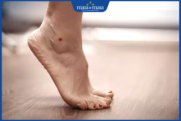 nốt ruồi son mắt cá chân