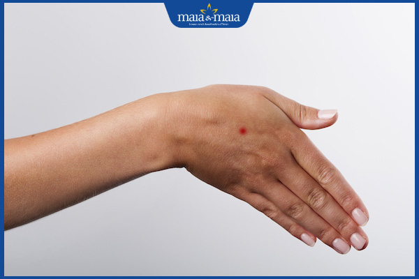 nốt ruồi son mu bàn tay