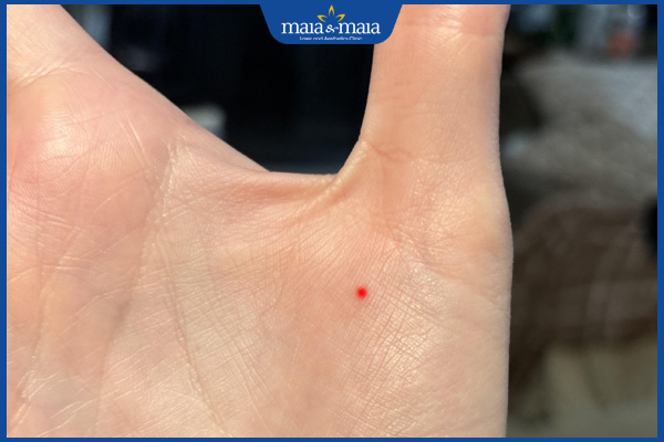 nốt ruồi son ngón cái