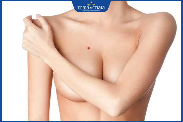 nốt ruồi son ngực nữ