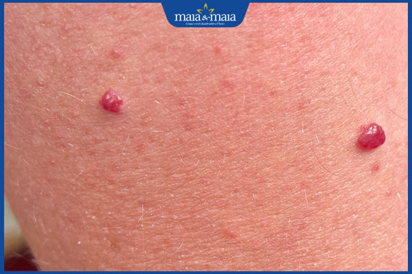 nốt ruồi son ở cánh tay