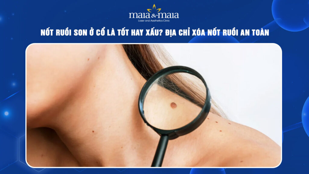 Nốt ruồi son ở cổ có ý nghĩa gì? Đây là tốt hay xấu? 1 Nốt ruồi son ở cổ