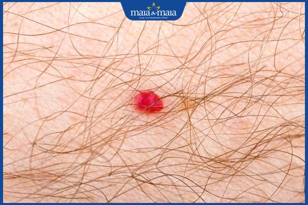 nốt ruồi son ở đầu