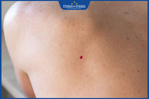 nốt ruồi son ở lưng