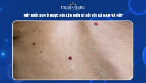 Nốt ruồi son ở ngực