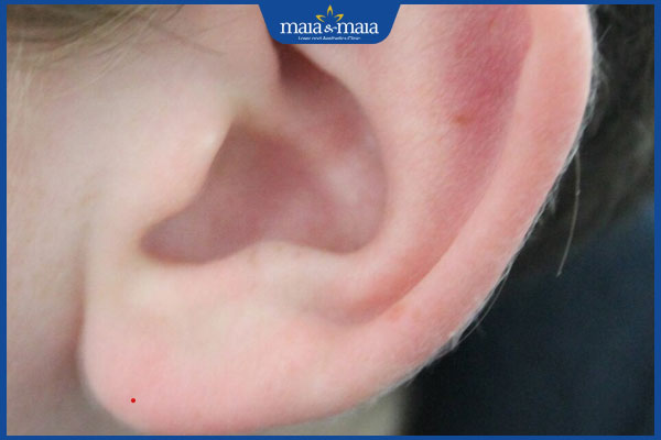 Khám phá ý nghĩa của từng vị trí nốt ruồi son phú quý 4 nốt ruồi son ở thùy tai