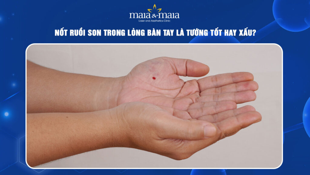 Nốt ruồi son trong lòng bàn tay