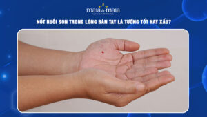 Nốt ruồi son trong lòng bàn tay