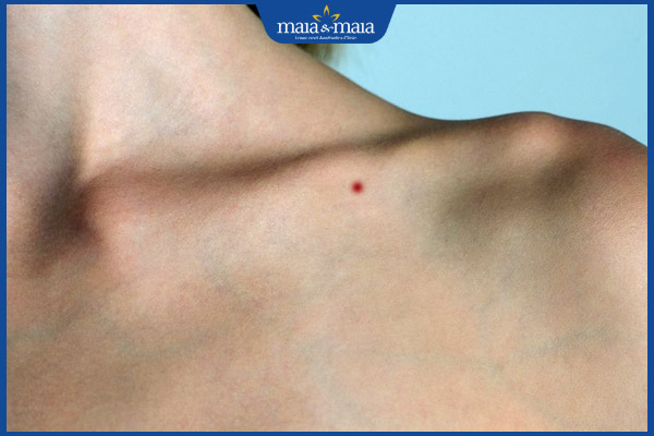 nốt ruồi son xương đòn