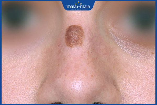 8 nốt ruồi xấu trên mặt phụ nữ và cách loại bỏ hiệu quả 4 nốt ruồi sống mũi