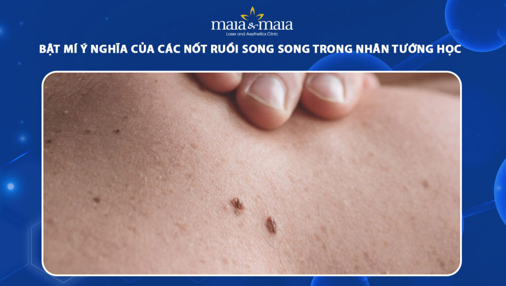 nốt ruồi song song