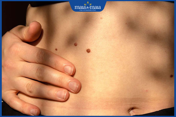 nốt ruồi song song ở bụng