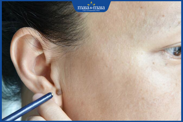 Luận giải ý nghĩa 6 vị trí nốt ruồi ở tai cho nam và nữ giới 2 nốt ruồi tai nữ