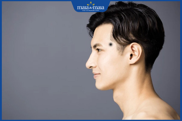 nốt ruồi thái dương trái