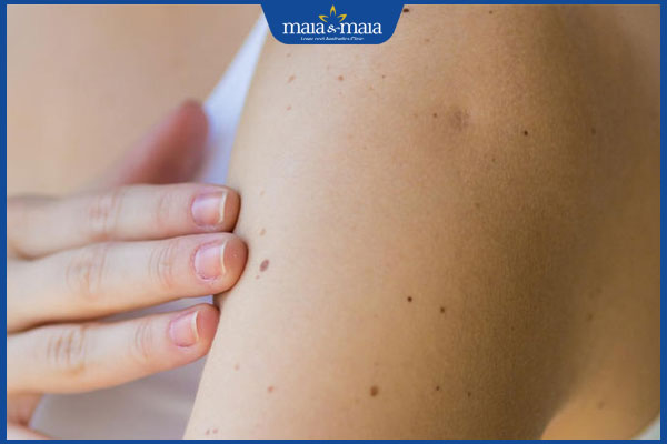 nốt ruồi thẳng hàng