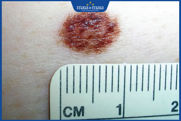 nốt ruồi thay đổi